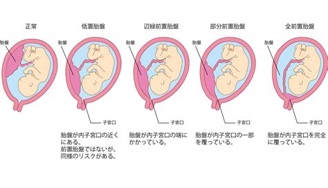 低位胎盤|【産婦人科医監修】前置胎盤・低置胎盤とは？出血す。